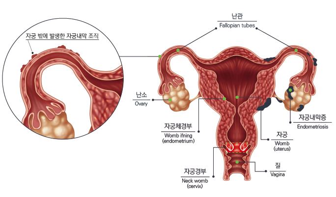 자궁내막증 한방치료가 좋은 이유 (2)