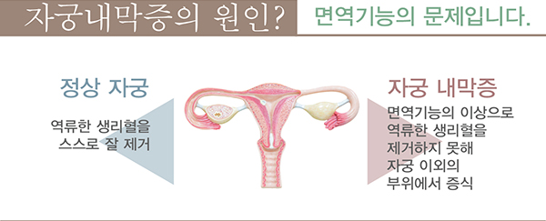 자궁내막증 한방치료가 좋은 이유 (4)