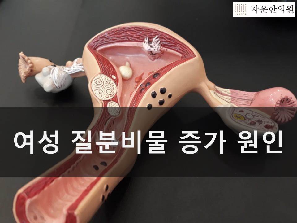 여성 질 분비물 증가하는 여러가지 원인알아보자!
