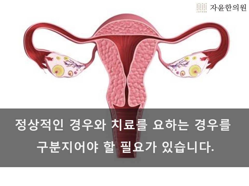 여성 질 분비물 증가하는 여러가지 원인알아보자! (2)