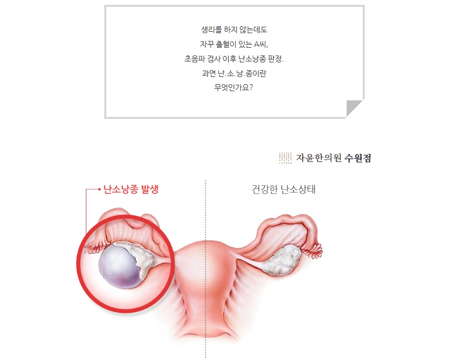 사례로 알아보는 난소낭종에 대한 궁금증 Q&A (3)