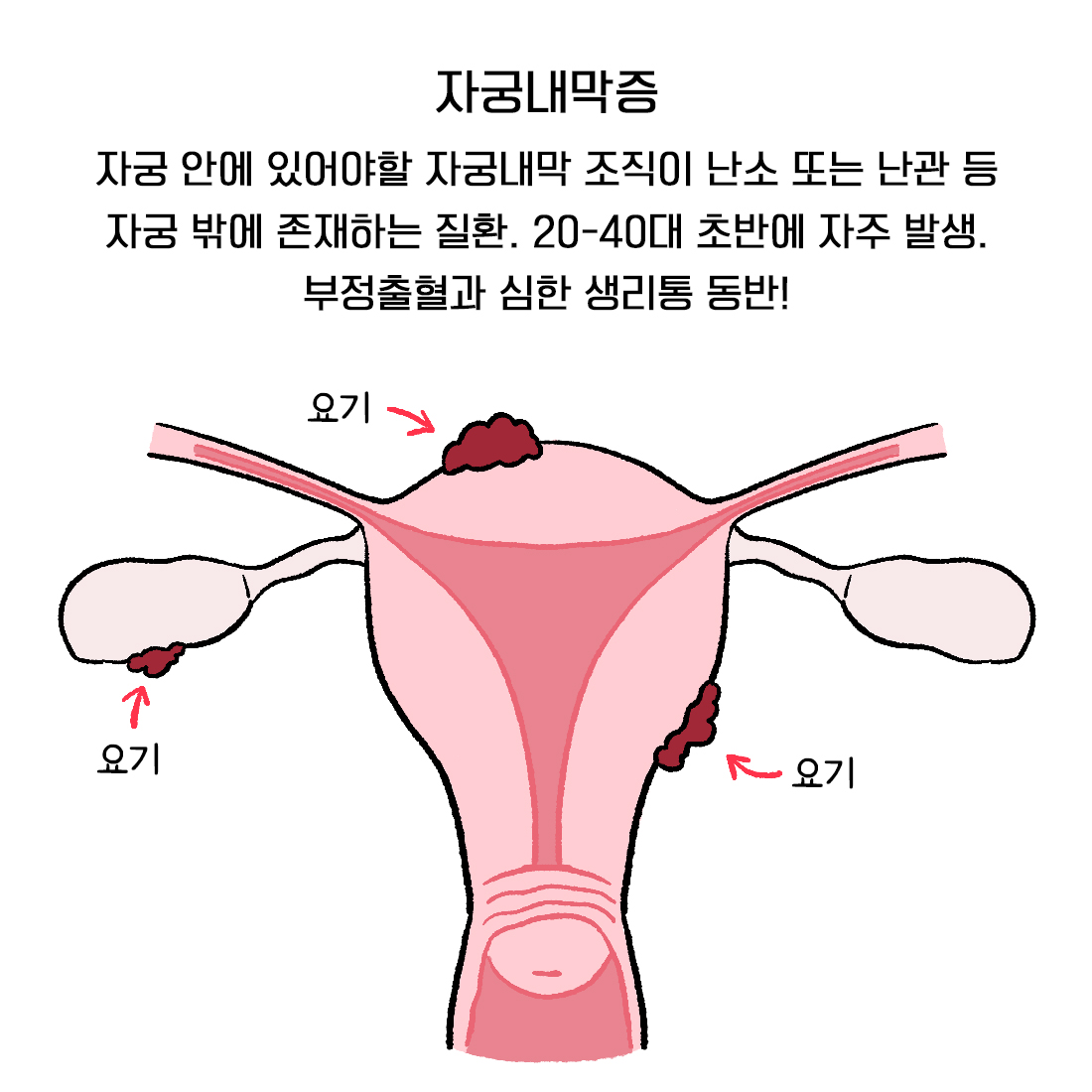 [자윤한의원 여성건강툰] 14화. 자궁내막증식증과 자궁내막증 뭐가 다를까? (4)
